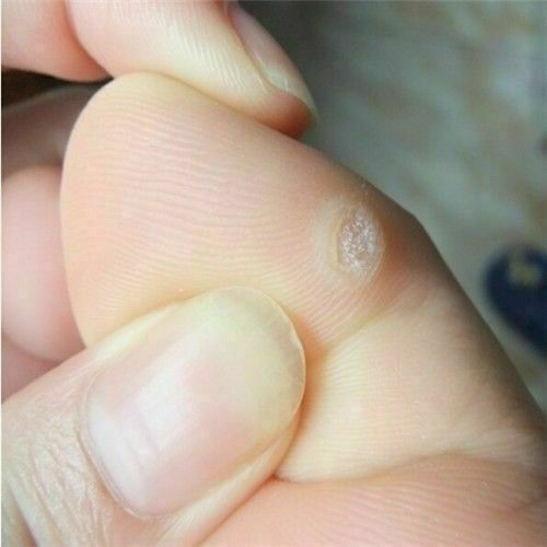 6Pcs Box Foot Corn Removal  Plaster with  Warts Thorn Patch Soften Skin Sticker